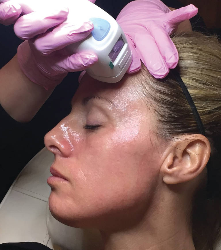 Emerge non-ablative fractional laser skin treatment